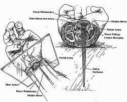 Medical diagram showing the placement of a nail in the wrist for crucifixion.